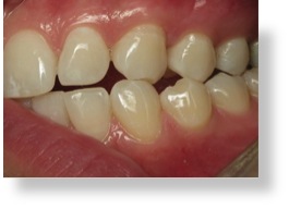 Tooth surface loss